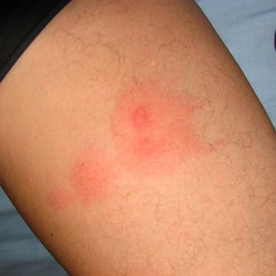 2007-03 Ushuaia Bedbugs